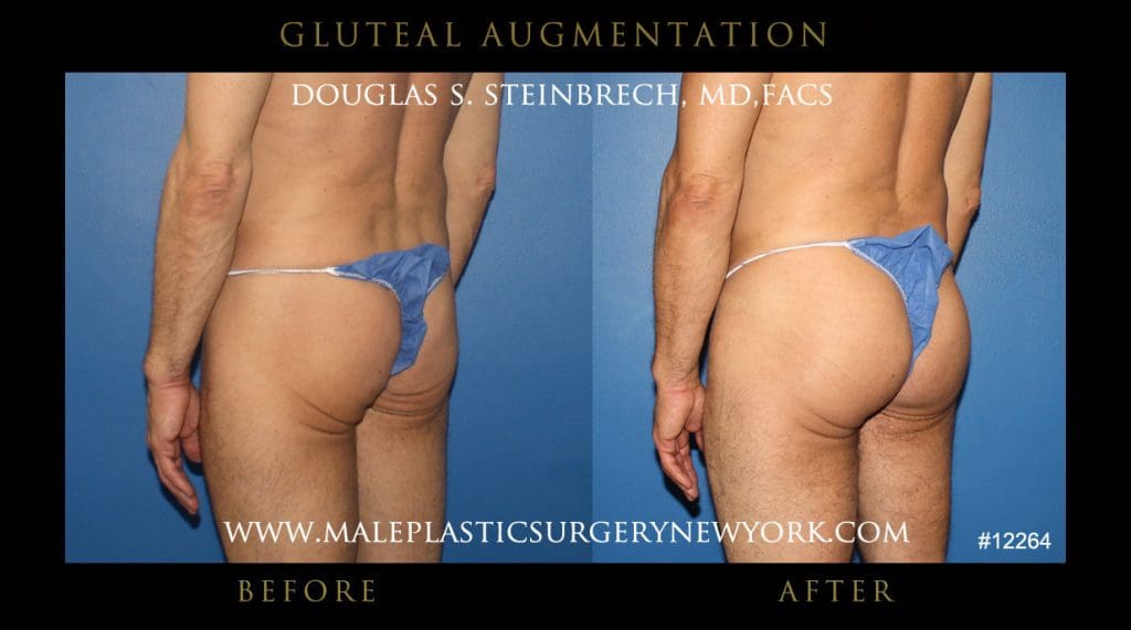 gluteal-aug-mps-ny-41