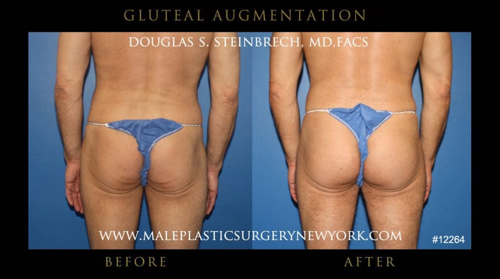 gluteal-aug-mps-ny-42