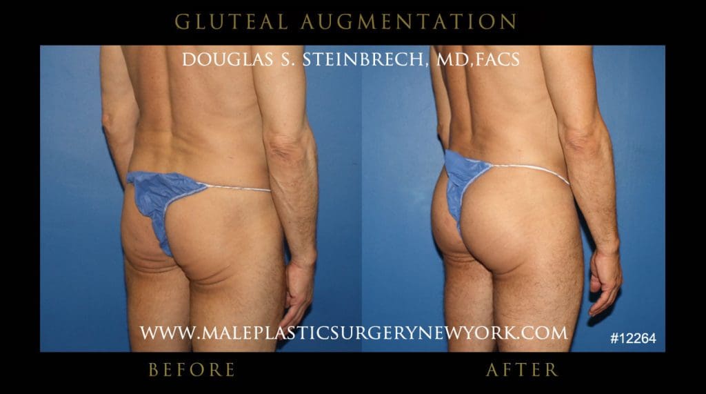 gluteal-aug-mps-ny-43