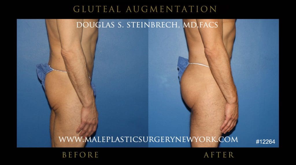 gluteal-aug-mps-ny-44