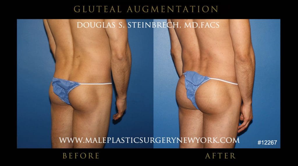gluteal-aug-mps-ny-45