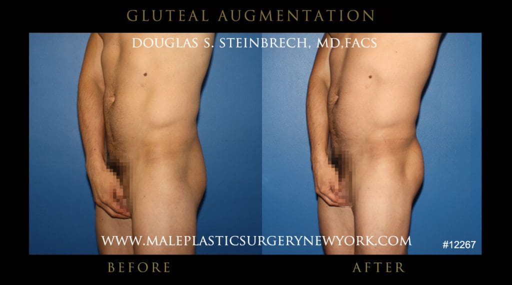 gluteal-aug-mps-ny-46
