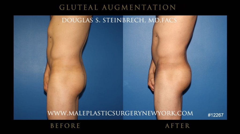 gluteal-aug-mps-ny-47