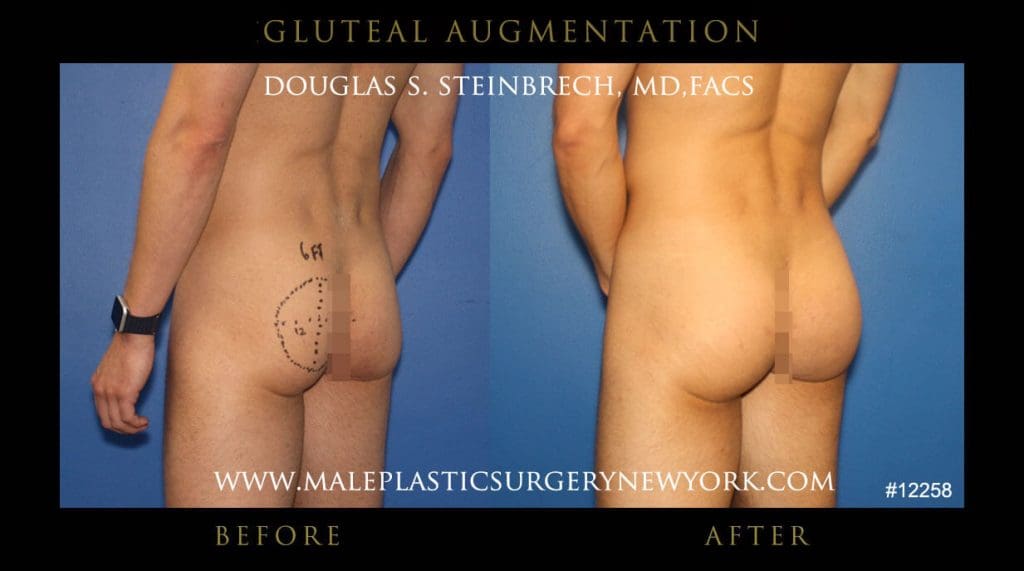 gluteal-aug-mps-ny-48