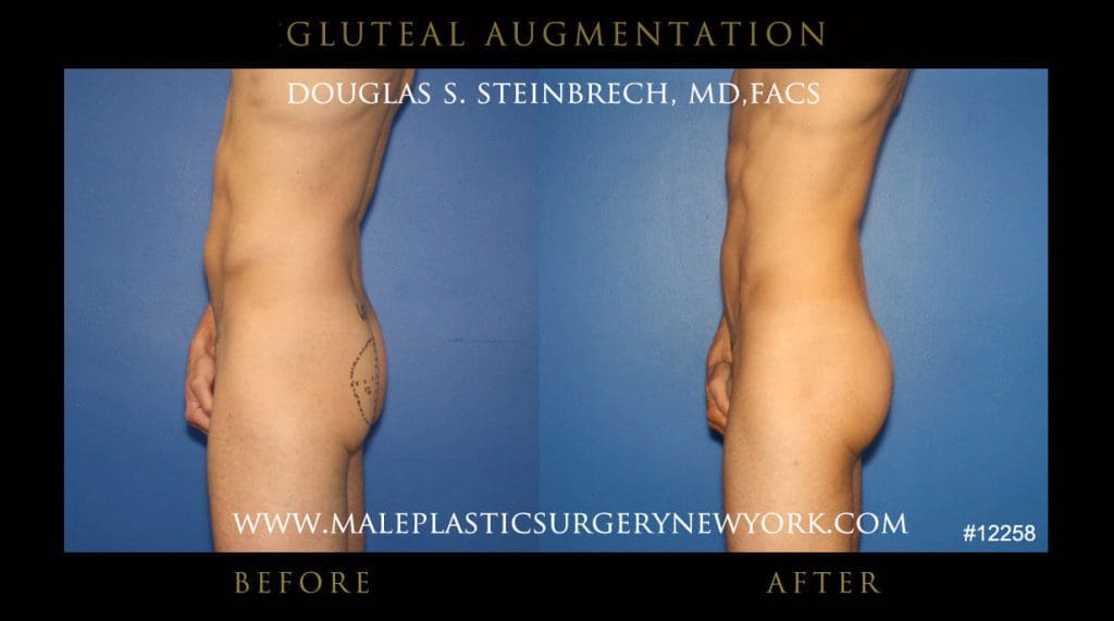 gluteal-aug-mps-ny-49