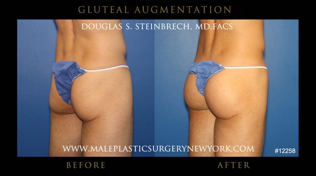 gluteal-aug-mps-ny-5