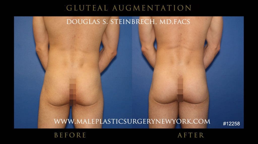 gluteal-aug-mps-ny-50