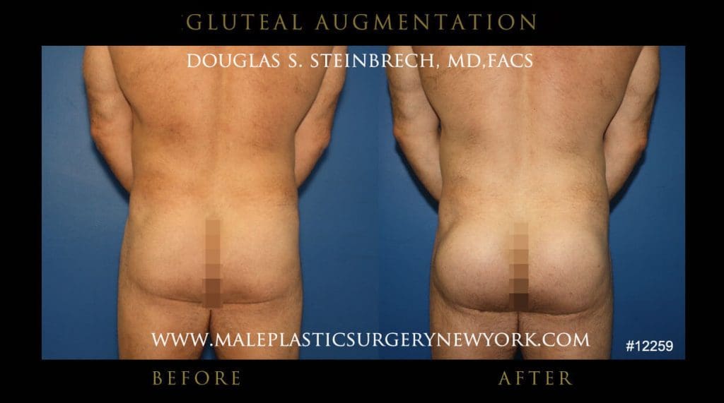 gluteal-aug-mps-ny-51