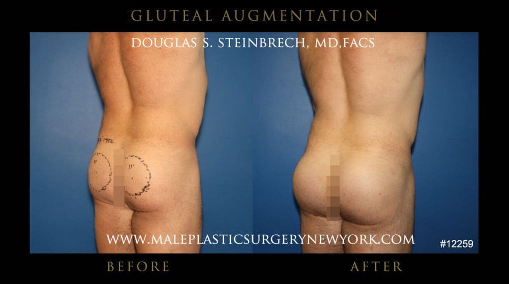 gluteal-aug-mps-ny-52