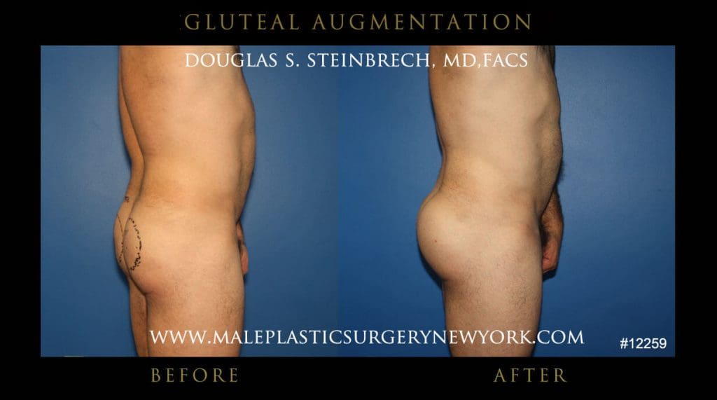gluteal-aug-mps-ny-53