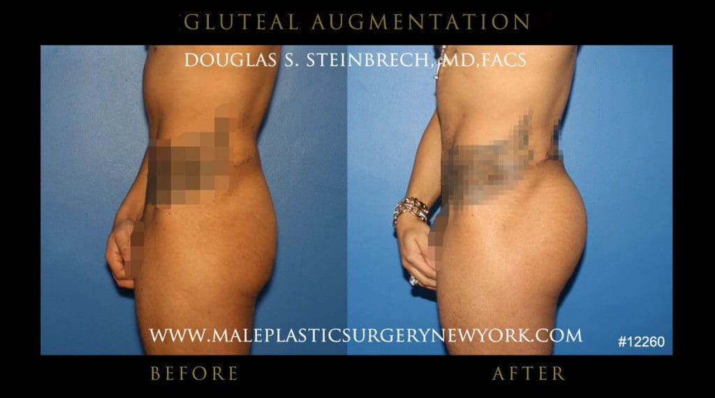 gluteal-aug-mps-ny-54