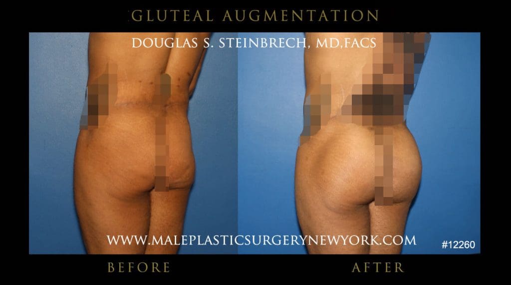 gluteal-aug-mps-ny-55