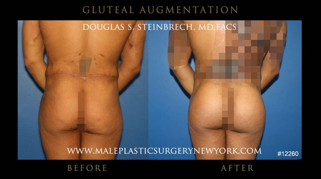 gluteal-aug-mps-ny-56
