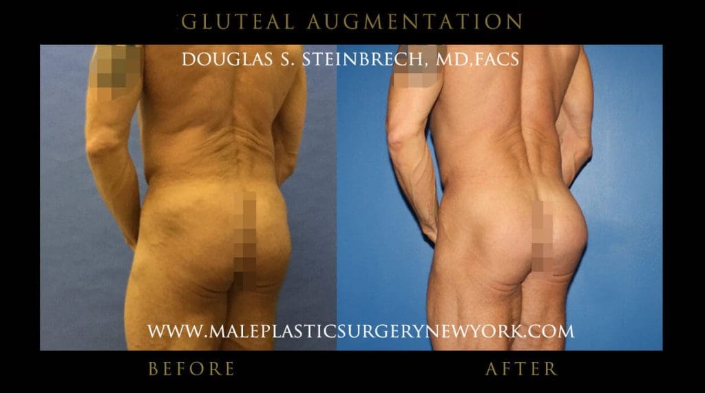 gluteal-aug-mps-ny-57