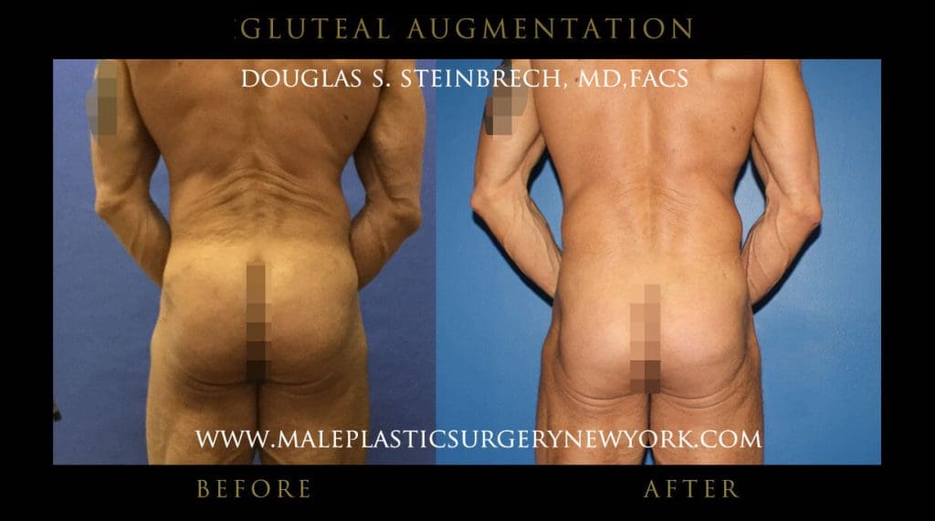 gluteal-aug-mps-ny-58