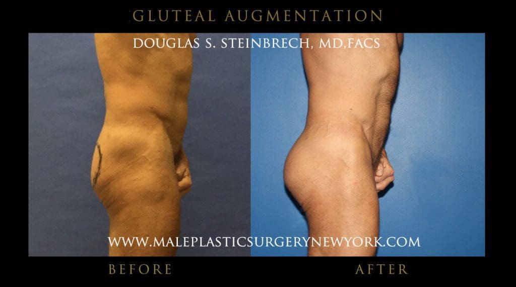 gluteal-aug-mps-ny-59