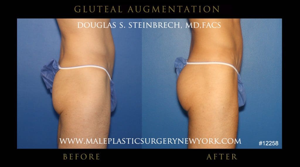 gluteal-aug-mps-ny-6