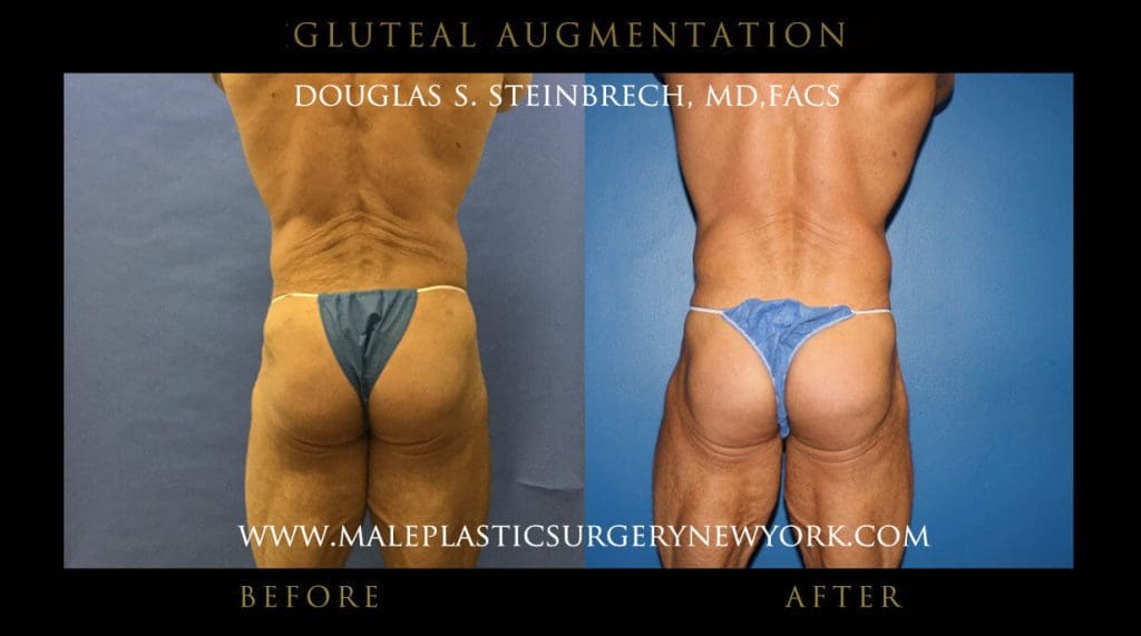 gluteal-aug-mps-ny-60