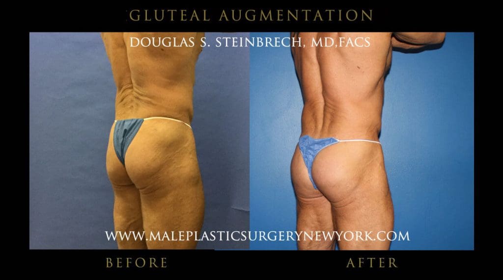 gluteal-aug-mps-ny-61