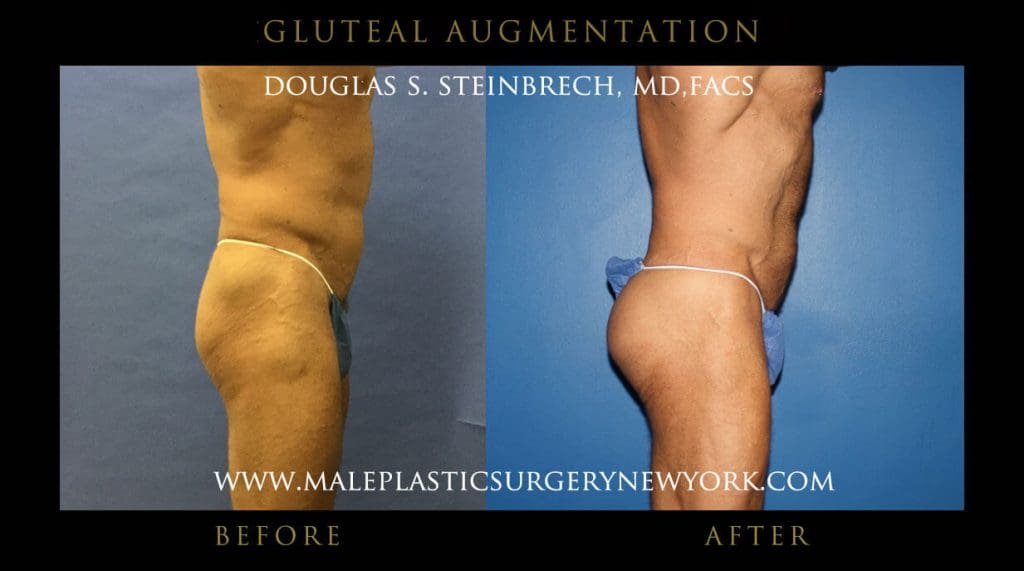 gluteal-aug-mps-ny-62