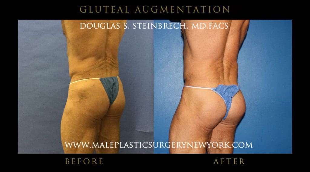 gluteal-aug-mps-ny-63