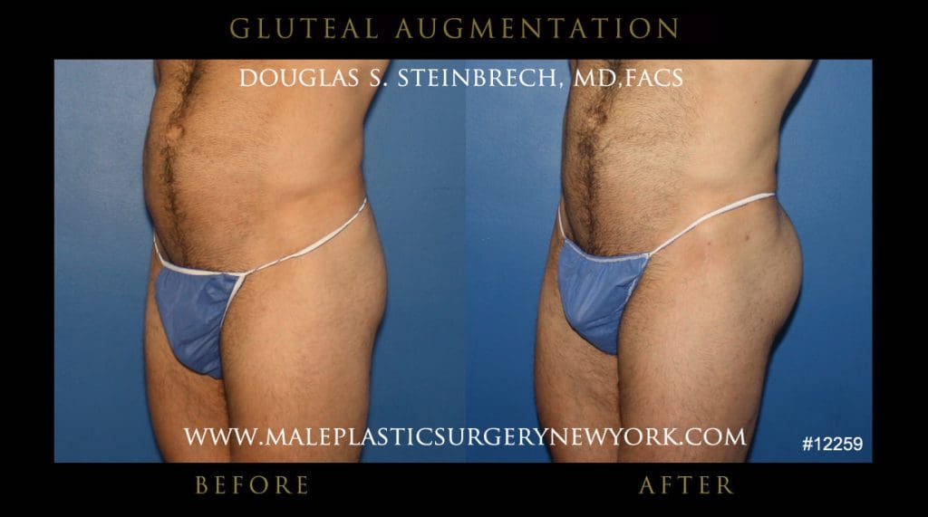 gluteal-aug-mps-ny-8