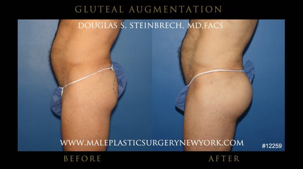 gluteal-aug-mps-ny-9