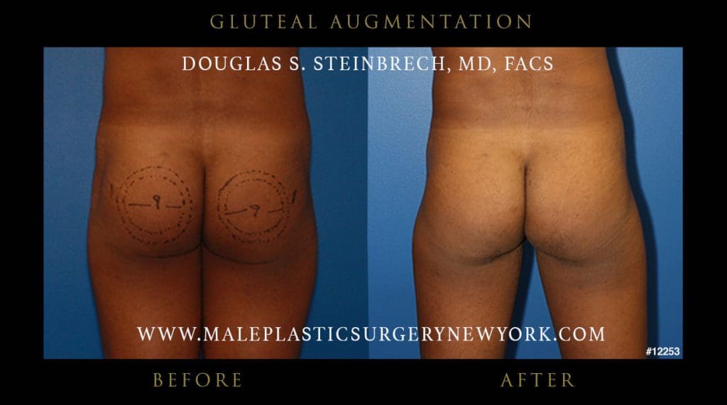 gluteal-augmentation-NYC-before-after-2-12253