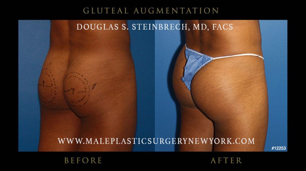 gluteal-augmentation-NYC-before-after-3-12253