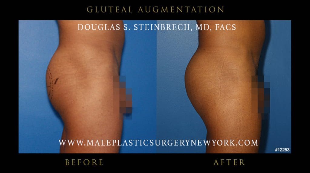 gluteal-augmentations-NYC-before-after-4-12253
