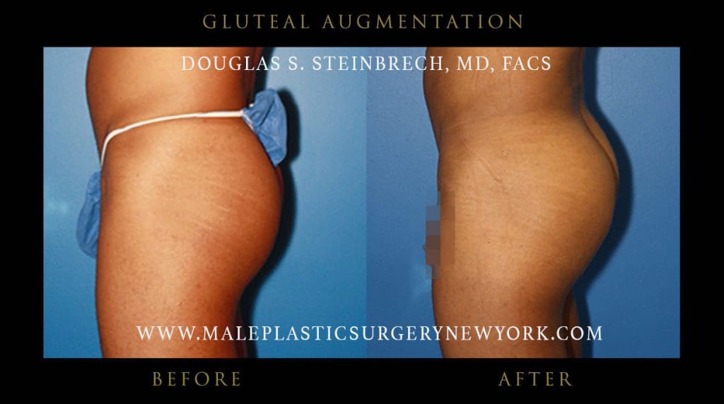 gluteal-augmentations-NYC-before-after-5-12253