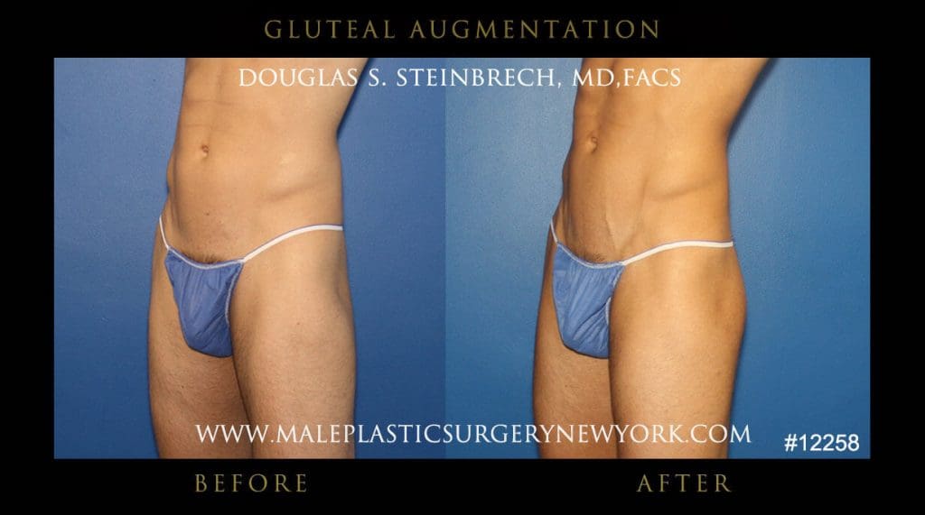 glutealaug1ny