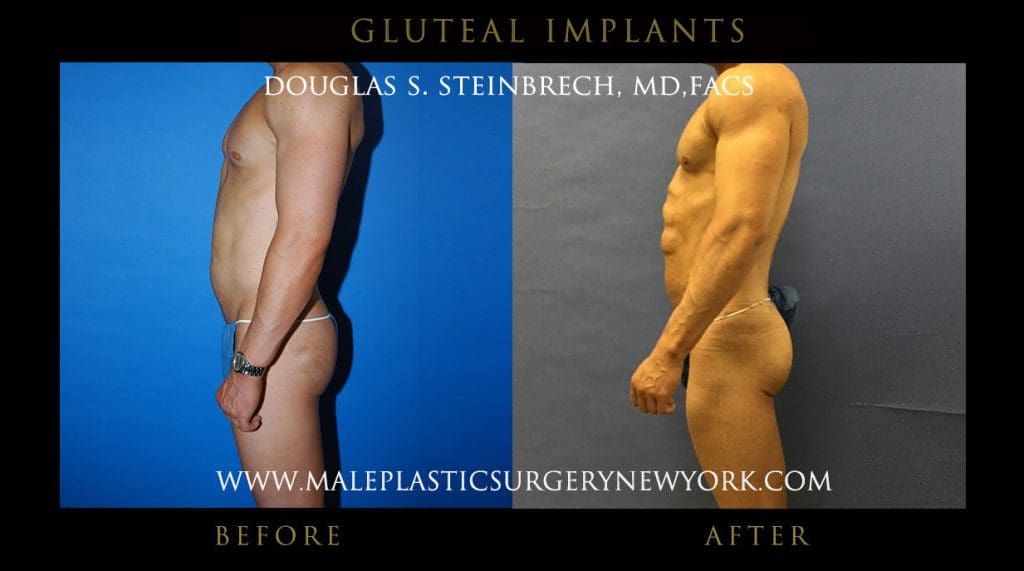 glutealimplantny2