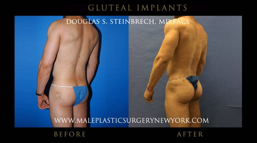 glutealimplantny3