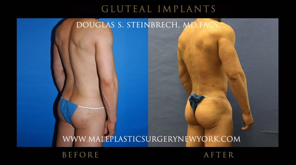 glutealimplantny5