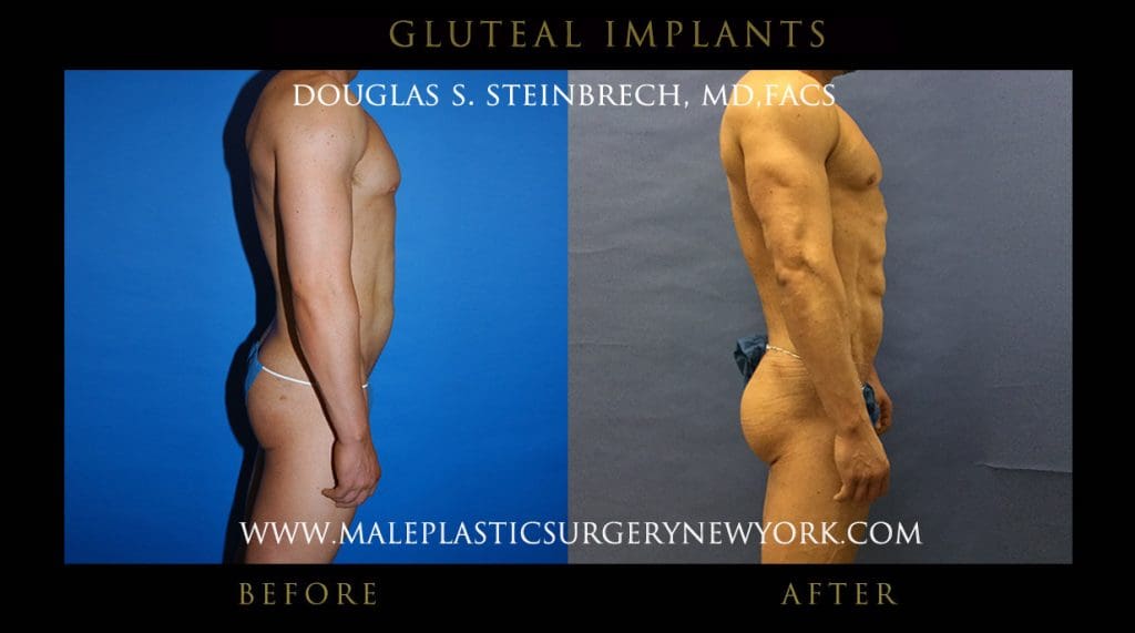 glutealimplantny6