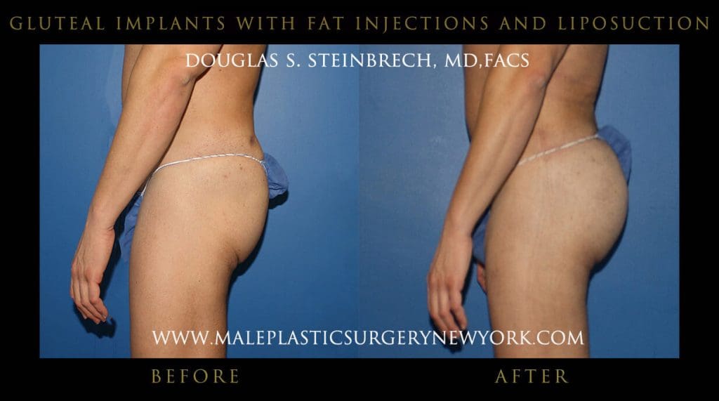 glutealimplantsfatny2