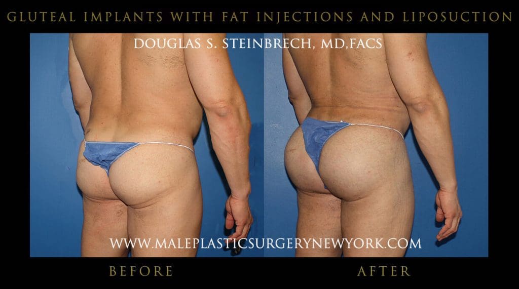 glutealimplantsfatny5
