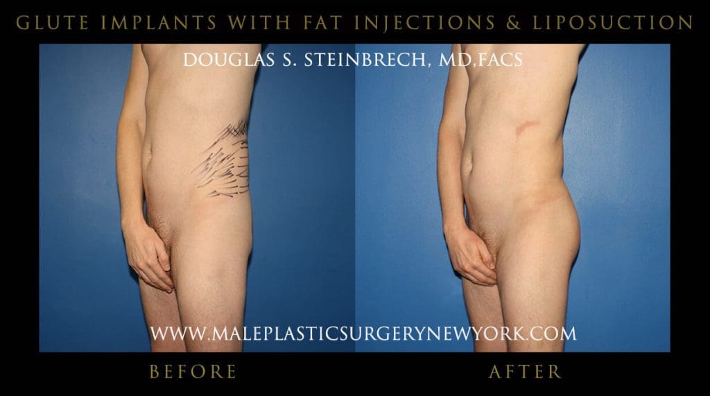 gluteimplantsny1
