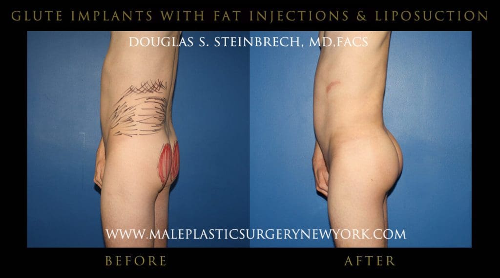 gluteimplantsny2