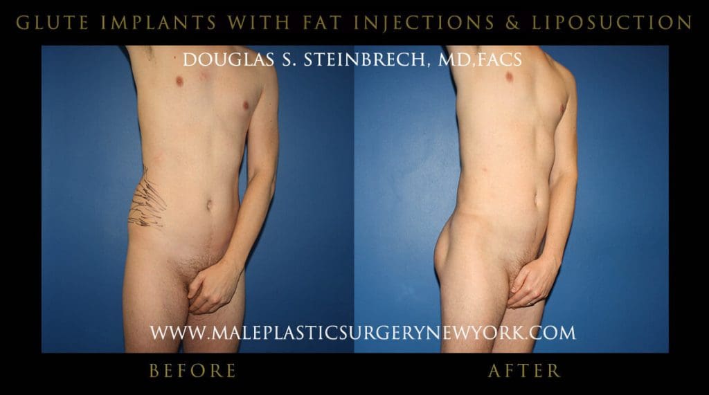 gluteimplantsny7