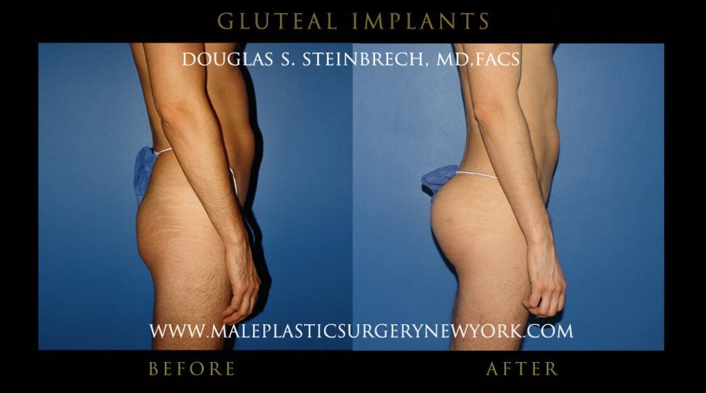 glutimplantsny3