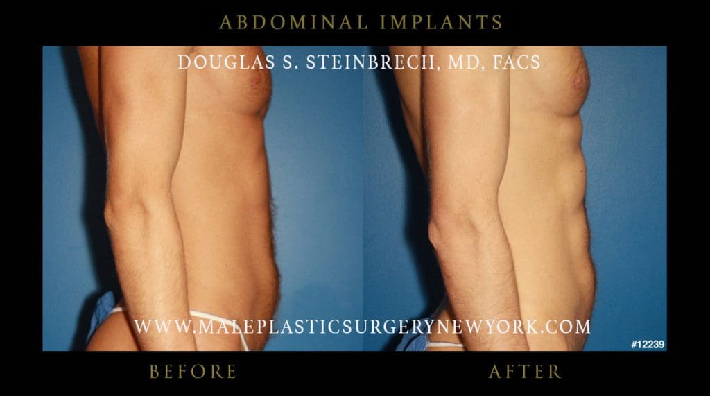 abdominal-implants-before-after-nyc-4-12239