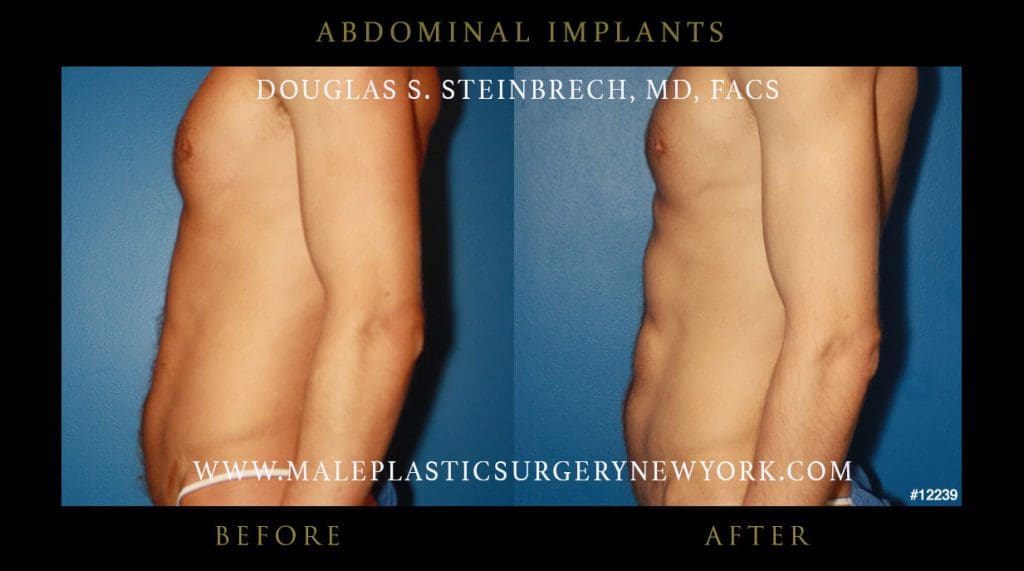 abdominal-implants-before-after-nyc-5-12239