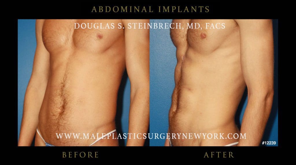 abdominal-implants-before-after-nyc-6-12239