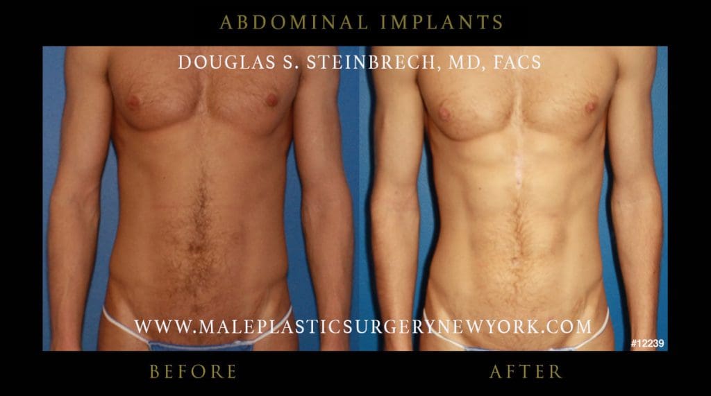 abdominal-implants-before-after-nyc-7-12239