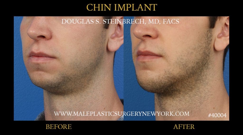 Chin Implant2