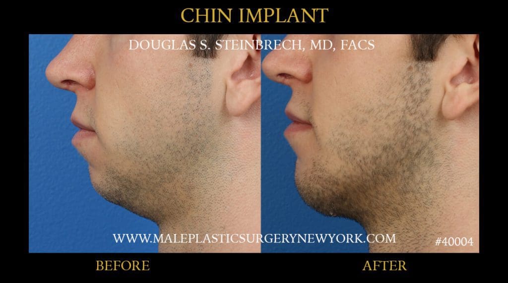 Chin Implant3