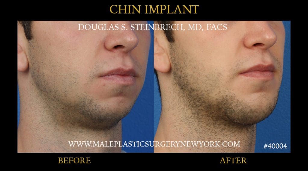 Chin Implant4