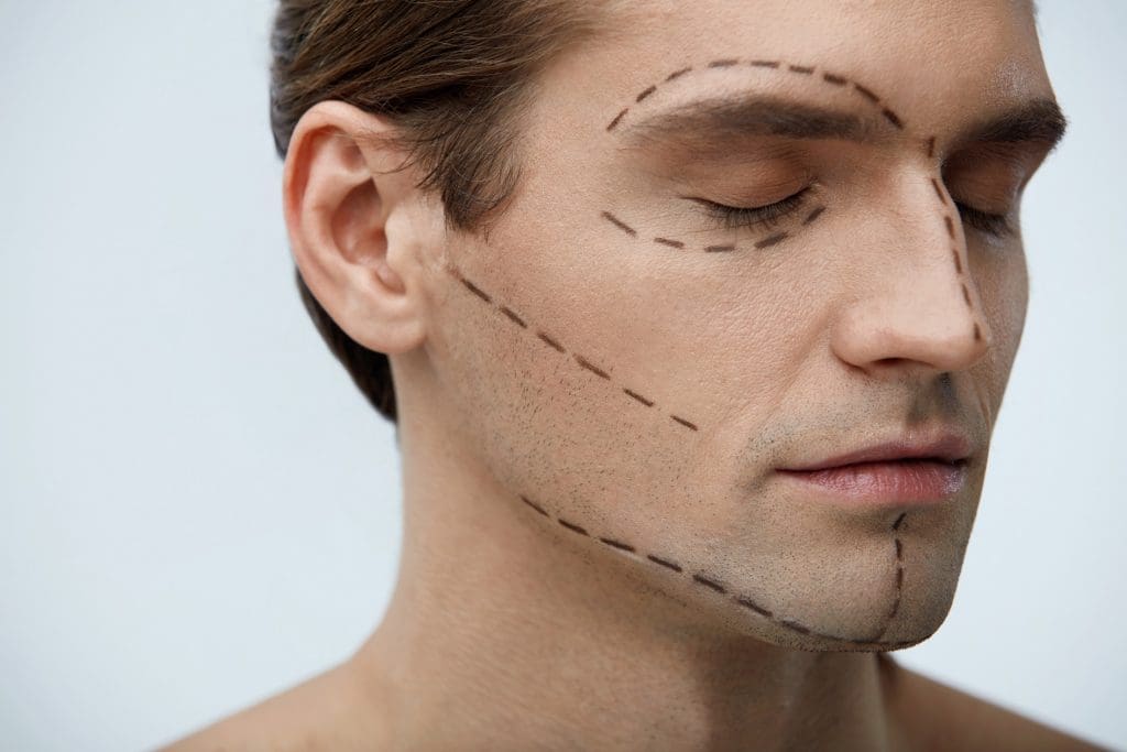 facial implants for men